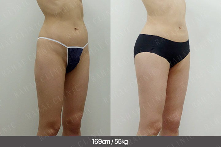 수술정보 <span>골반지방이식+복부지방흡입