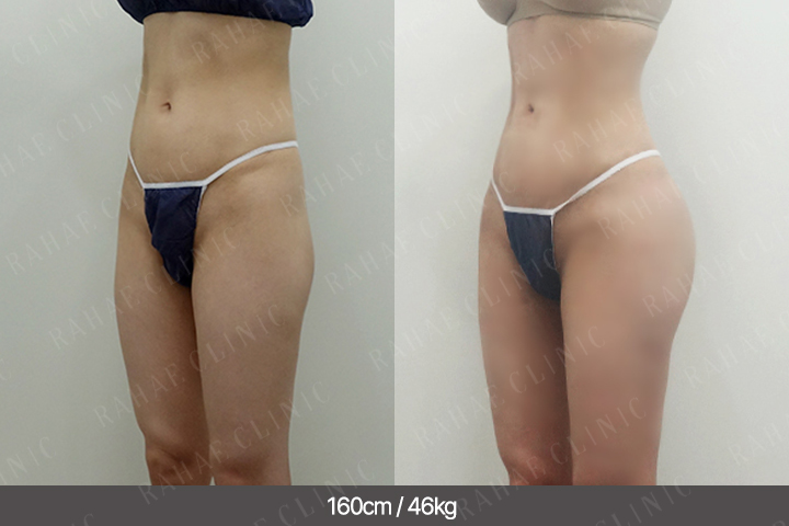 수술정보 <span>골반지방이식+엉덩이지방이식+복부지방흡입