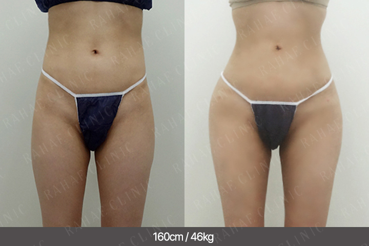 수술정보 <span>골반지방이식+엉덩이지방이식+복부지방흡입