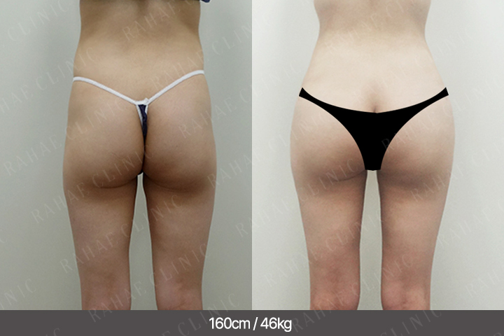 수술정보 <span>골반지방이식+엉덩이지방이식+복부지방흡입