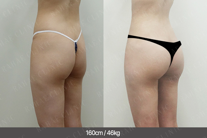 수술정보 <span>골반지방이식+엉덩이지방이식+복부지방흡입