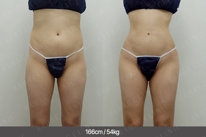 수술정보 <span>엉덩이지방이식+복부지방흡입