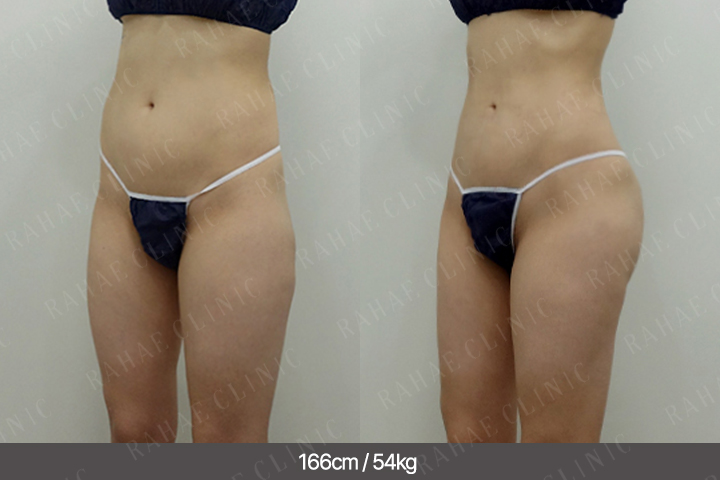 수술정보 <span>엉덩이지방이식+복부지방흡입