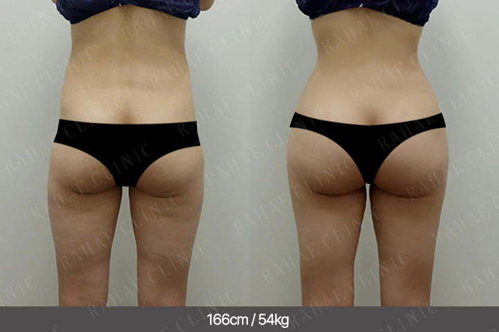 수술정보 <span>엉덩이지방이식+복부지방흡입