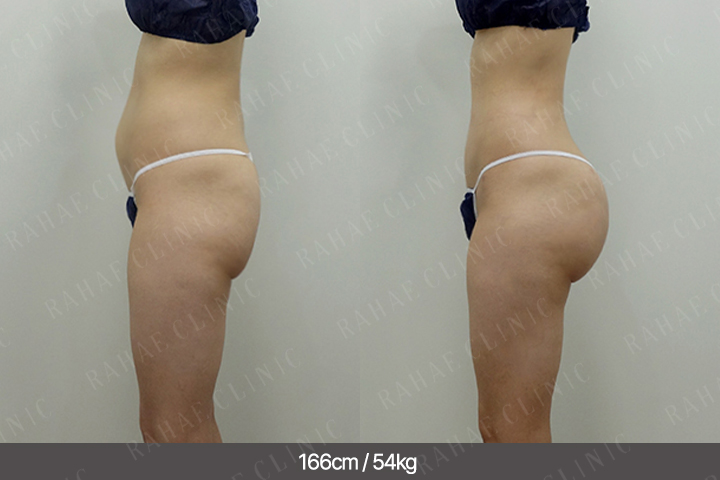 수술정보 <span>엉덩이지방이식+복부지방흡입