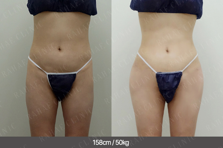 수술정보 <span>골반지방이식+엉덩이지방이식+복부지방흡입반