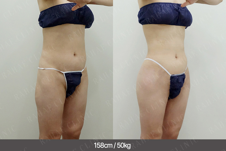 수술정보 <span>골반지방이식+엉덩이지방이식+복부지방흡입반