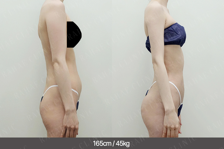 수술정보 <span>골반지방이식+엉덩이지방이식+복부지방흡입+팔지방흡입