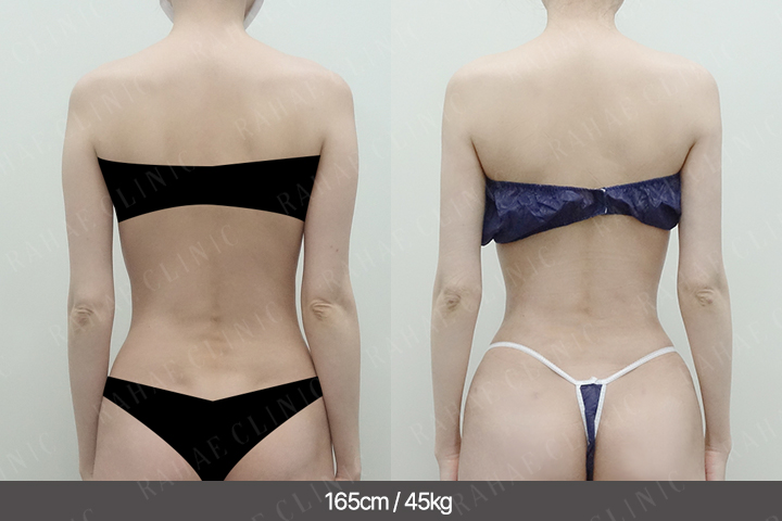 수술정보 <span>골반지방이식+엉덩이지방이식+복부지방흡입+팔지방흡입