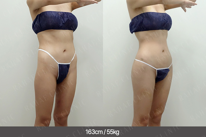 수술정보 <span>골반지방이식+엉덩이지방이식+복부지방흡입