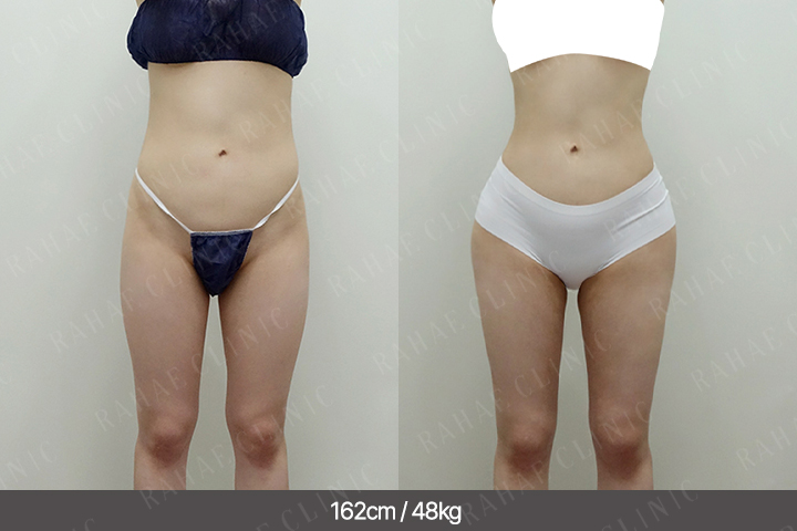 수술정보 <span>골반지방이식+엉덩이지방이식+허벅지지방흡입