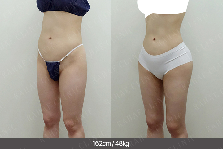 수술정보 <span>골반지방이식+엉덩이지방이식+허벅지지방흡입