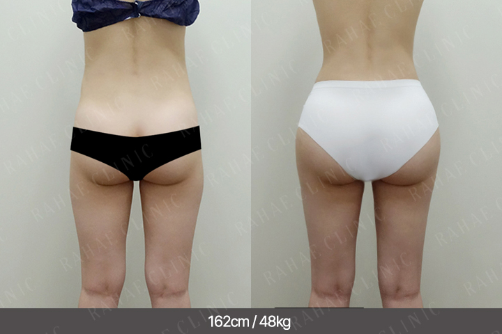 수술정보 <span>골반지방이식+엉덩이지방이식+허벅지지방흡입