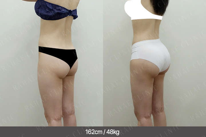 수술정보 <span>골반지방이식+엉덩이지방이식+허벅지지방흡입