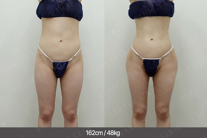 수술정보 <span>골반지방이식+엉덩이지방이식+허벅지지방흡입