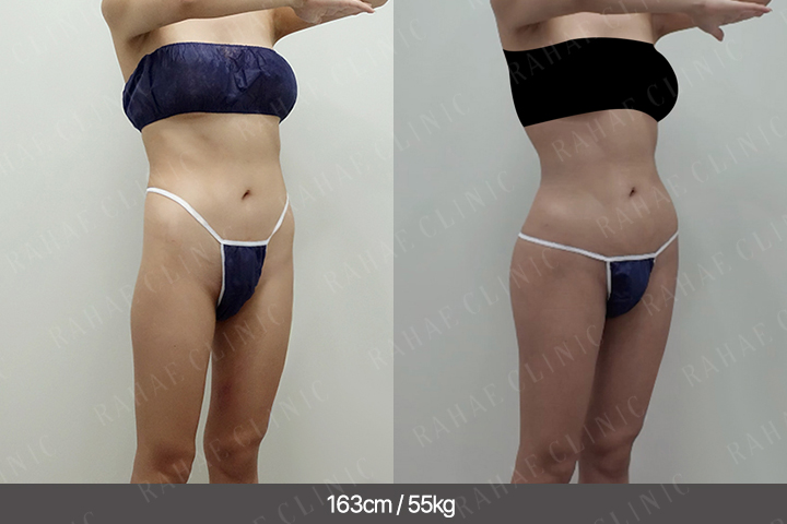 수술정보 <span>골반지방이식+엉덩이지방이식+복부지방흡입