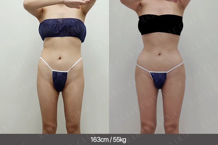 수술정보 <span>골반지방이식+엉덩이지방이식+복부지방흡입