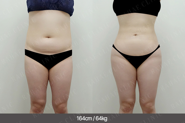 수술정보 <span>골반지방이식+엉덩이지방이식+복부지방흡입