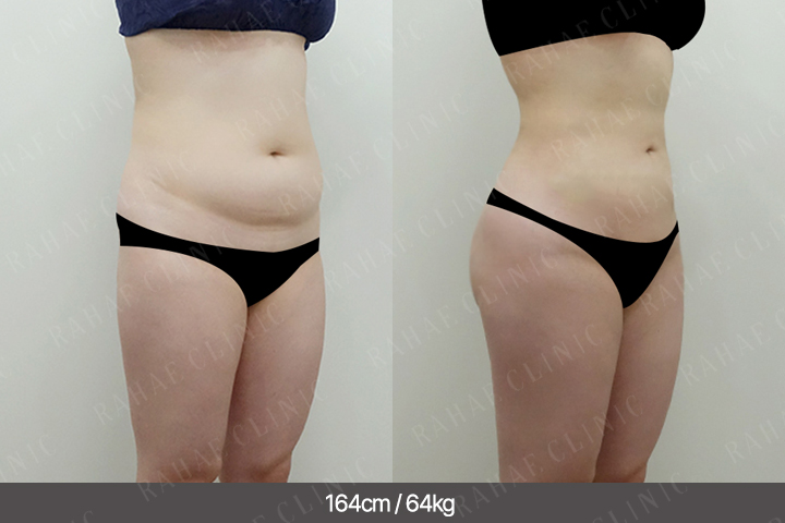 수술정보 <span>골반지방이식+엉덩이지방이식+복부지방흡입