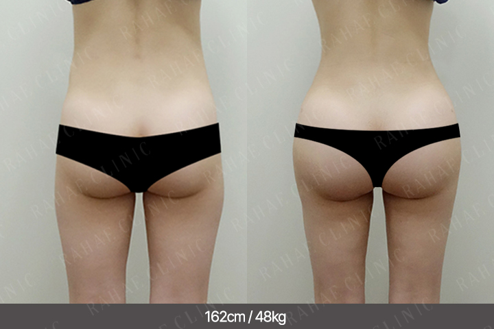 수술정보 <span>골반지방이식+엉덩이지방이식+복부지방흡입