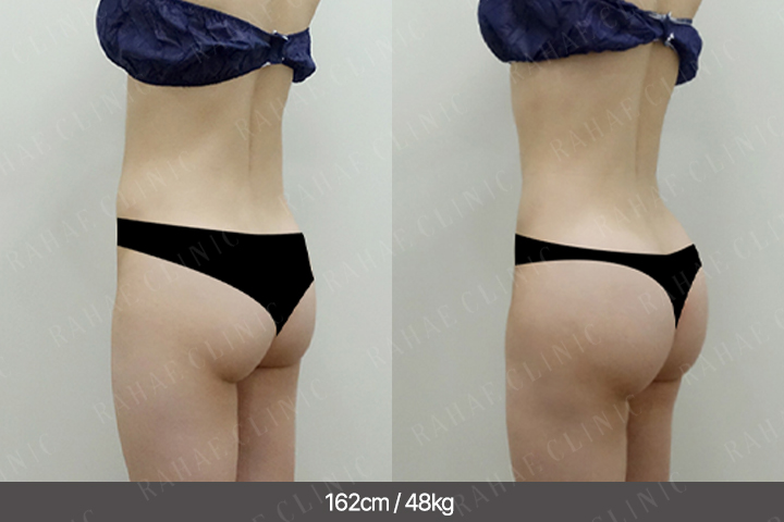 수술정보 <span>골반지방이식+엉덩이지방이식+복부지방흡입