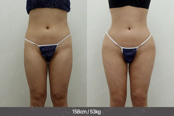 수술정보 <span>골반지방이식+엉덩이지방이식+복부지방흡입