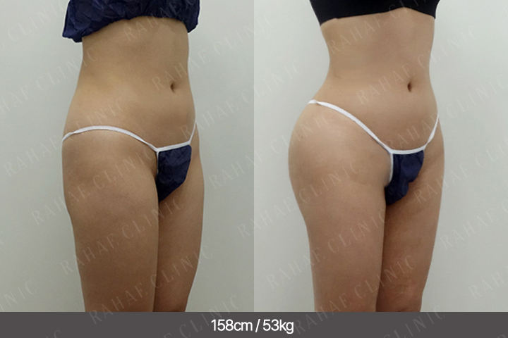 수술정보 <span>골반지방이식+엉덩이지방이식+복부지방흡입