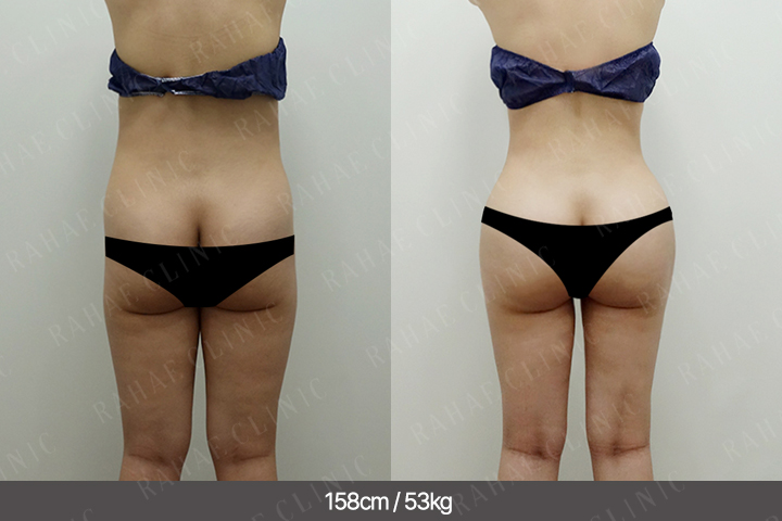 수술정보 <span>골반지방이식+엉덩이지방이식+복부지방흡입