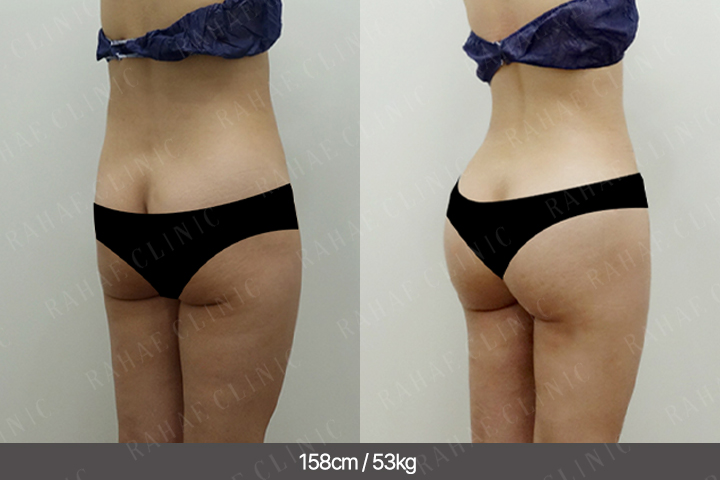 수술정보 <span>골반지방이식+엉덩이지방이식+복부지방흡입