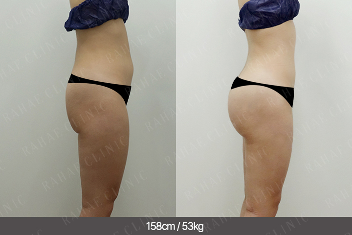 수술정보 <span>골반지방이식+엉덩이지방이식+복부지방흡입