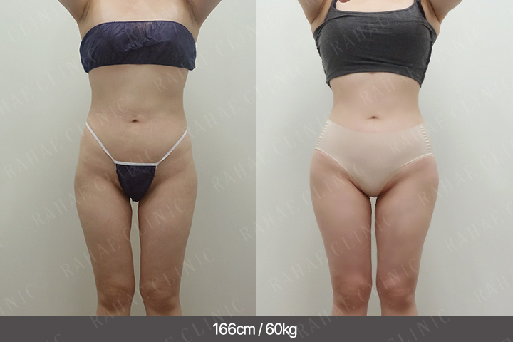 수술정보 <span>골반지방이식+엉덩이지방이식+복부지방흡입