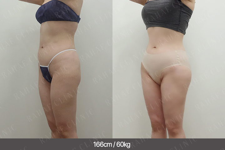 수술정보 <span>골반지방이식+엉덩이지방이식+복부지방흡입