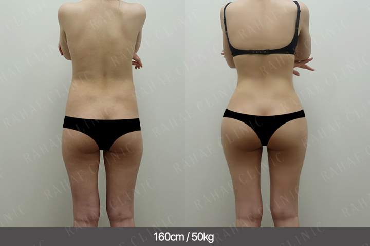 수술정보 <span>골반지방이식+엉덩이지방이식+복부지방흡입