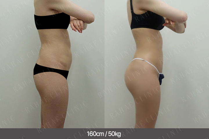 수술정보 <span>골반지방이식+엉덩이지방이식+복부지방흡입