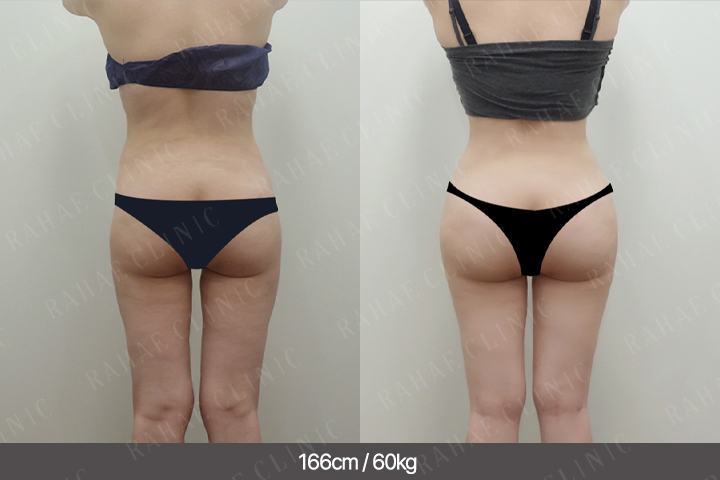 수술정보 <span>골반지방이식+엉덩이지방이식+복부지방흡입