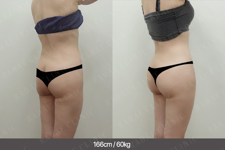 수술정보 <span>골반지방이식+엉덩이지방이식+복부지방흡입