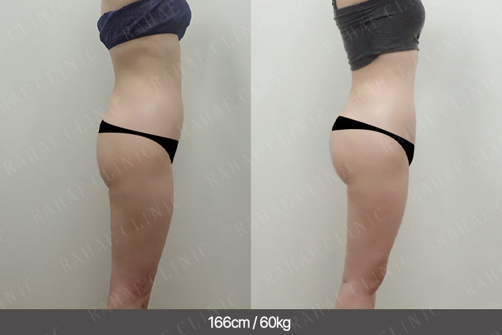 수술정보 <span>골반지방이식+엉덩이지방이식+복부지방흡입