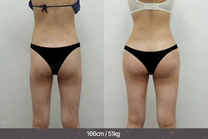 수술정보 <span>골반지방이식+엉덩이지방이식+복부지방흡입