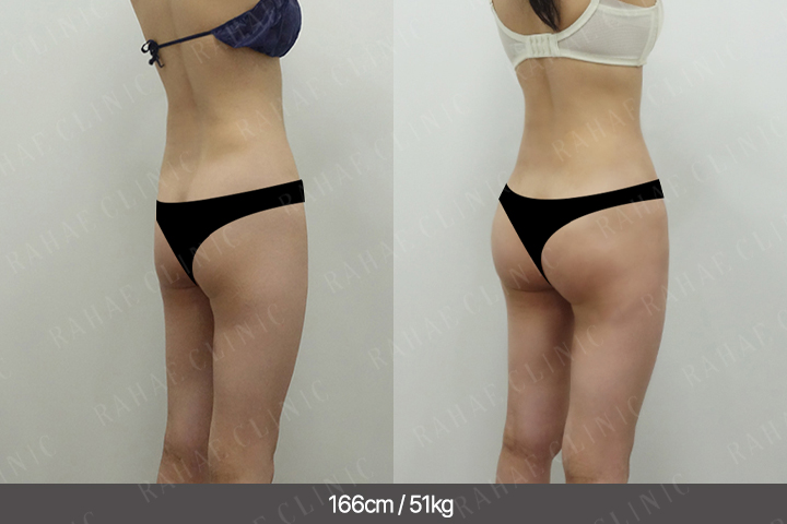 수술정보 <span>골반지방이식+엉덩이지방이식+복부지방흡입