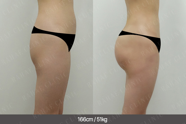 수술정보 <span>골반지방이식+엉덩이지방이식+복부지방흡입