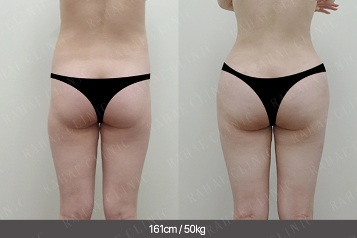 수술정보 <span>골반지방이식+엉덩이지방이식+복부지방흡입