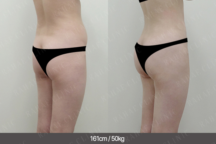 수술정보 <span>골반지방이식+엉덩이지방이식+복부지방흡입