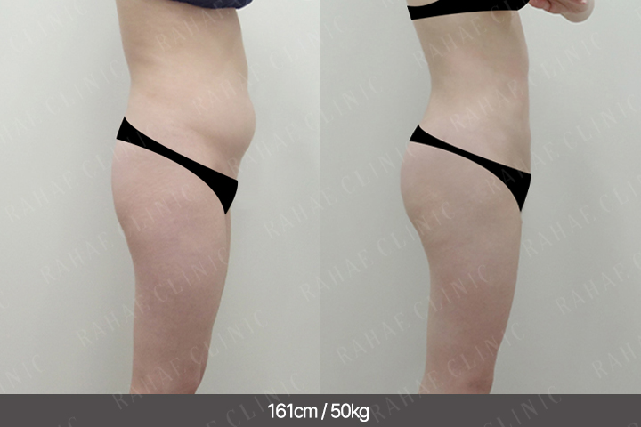 수술정보 <span>골반지방이식+엉덩이지방이식+복부지방흡입