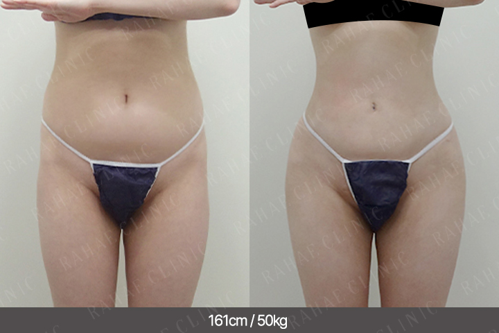 수술정보 <span>복부지방흡입+골반지방이식+엉덩이지방이식