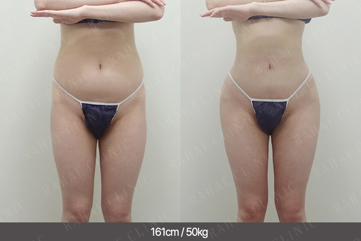 수술정보 <span>골반지방이식+엉덩이지방이식+복부지방흡입