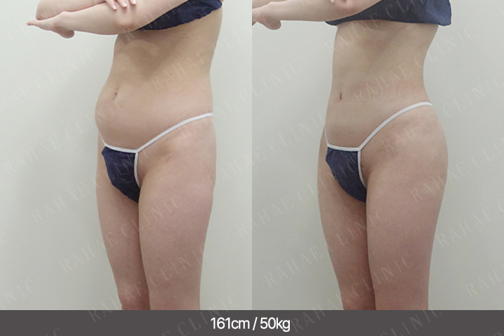 수술정보 <span>골반지방이식+엉덩이지방이식+복부지방흡입