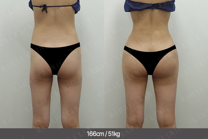 수술정보 <span>골반지방이식+엉덩이지방이식+복부지방흡입