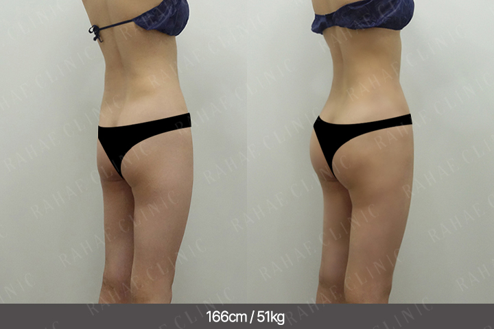 수술정보 <span>골반지방이식+엉덩이지방이식+복부지방흡입