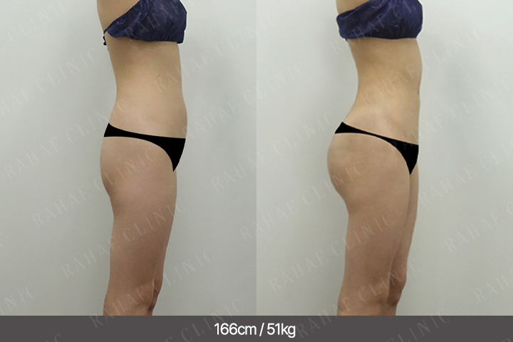 수술정보 <span>골반지방이식+엉덩이지방이식+복부지방흡입