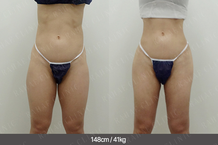 수술정보 <span>골반지방이식+엉덩이지방이식+복부지방흡입
